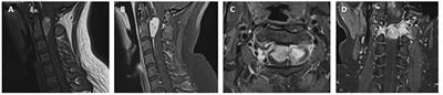 Malignant Transformation and Metastatic Spread of Dumbbell-Shaped Meningeal Melanocytoma of the Cervical Spine: A Case Report and Literature Review